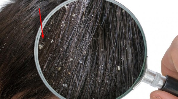 Manfaat minyak lavender untuk rambut berketombe